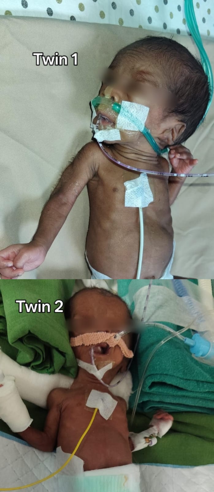 Raising funds for my 35 days old twin babies