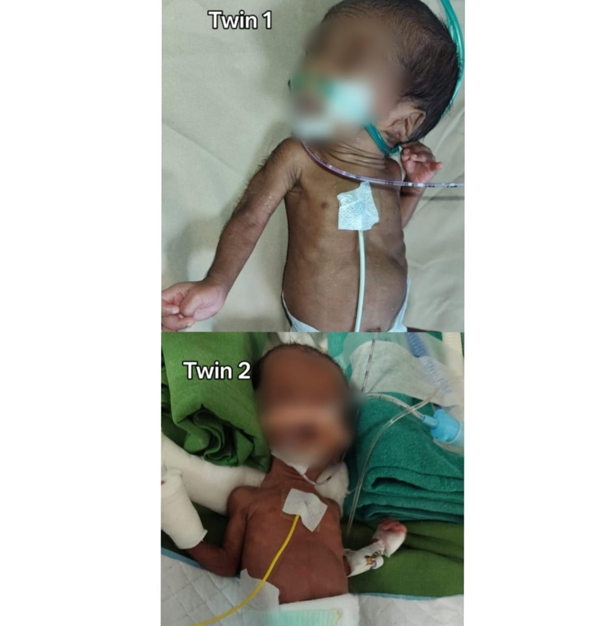 Raising funds for my 35 days old twin babies
